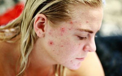 3 Mistakes Will Make Your Pimples Angrier